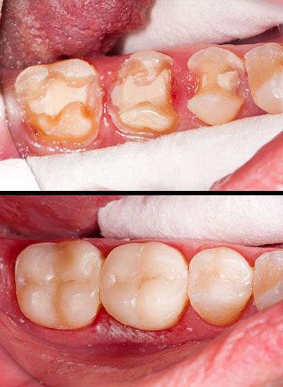 The image shows two photographs of an open mouth with teeth in various states of decay and damage, emphasizing dental health issues.