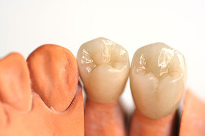 The image shows three artificial teeth with varying levels of wear and staining, likely for educational purposes related to dental care or restoration.