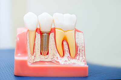 The image shows a model of human teeth with visible dental implants and screws, displayed on a pink background, which resembles a mouth cast or a dental patient s mouth.