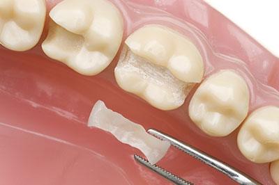 The image shows a close-up view of a dental implant being placed into a tooth socket with a surgical tool visible.