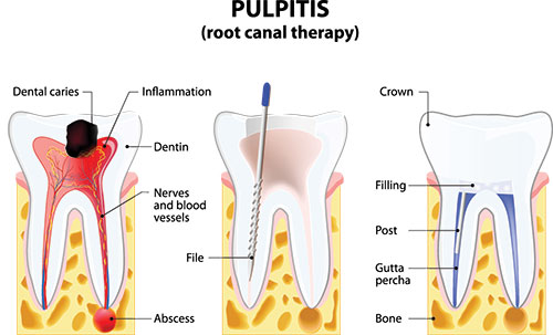The image displays a diagrammatic representation of a dental implant procedure, with labeled parts such as  root canal therapy,   dental caries,   inflammation,   crown,   filling,   post,  and  abscess,  illustrating the process of placing an implant in a tooth socket.