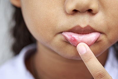 The image shows a close-up of a person s face with acne on their nose, who appears to be a child, with a finger pointing at one of the blemishes.
