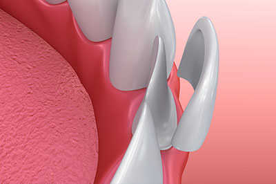 A digital illustration of a dental implant with a pink gum area and a metal screw component, set against a medical background.