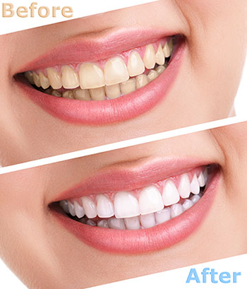 The image shows a before-and-after comparison of dental teeth whitening with a smiling woman s teeth demonstrating the result after treatment, emphasizing the transformation from discolored to clean and white teeth.
